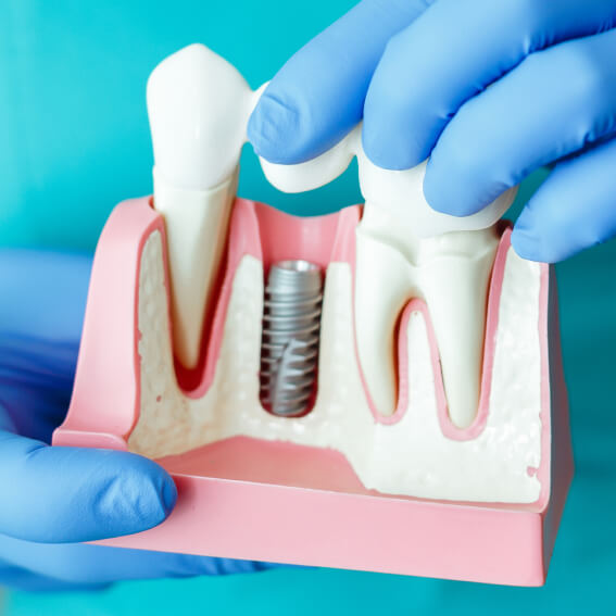 a model set of teeth displaying how dental implants work